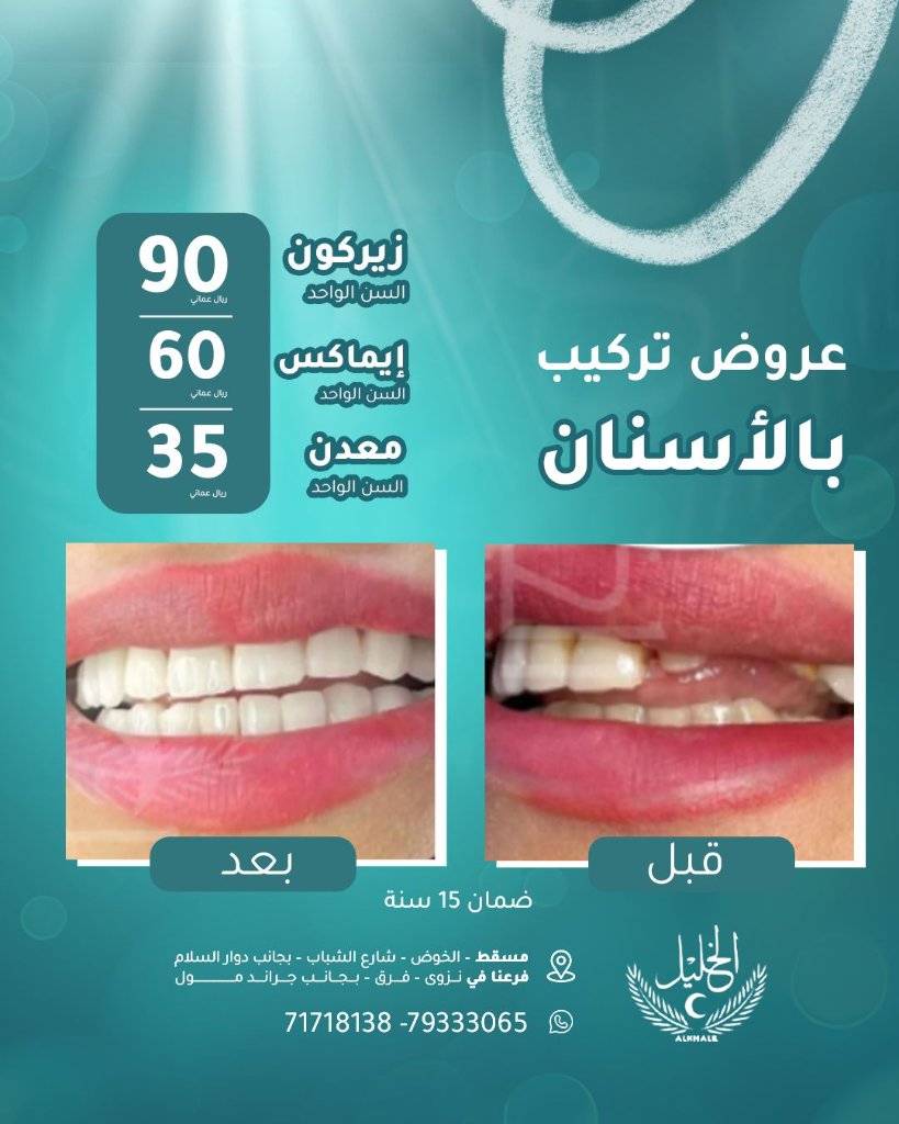 Emax Veneers result at Alkhalil Dental Center in Muscat, Oman