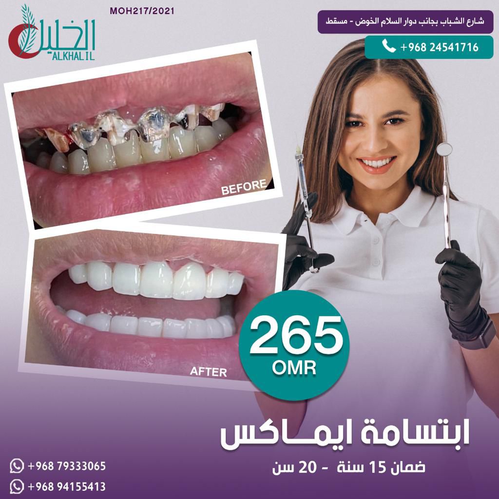 Emax Veneers result at Alkhalil Dental Center in Muscat, Oman