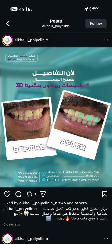 Emax Veneers transformation at Alkhalil Dental Center in Muscat, Oman