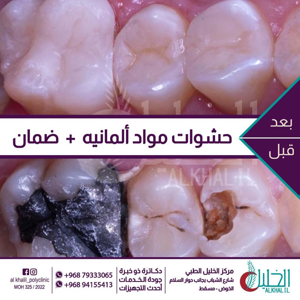 Dental fillings result at Alkhalil Dental Center in Muscat, Oman