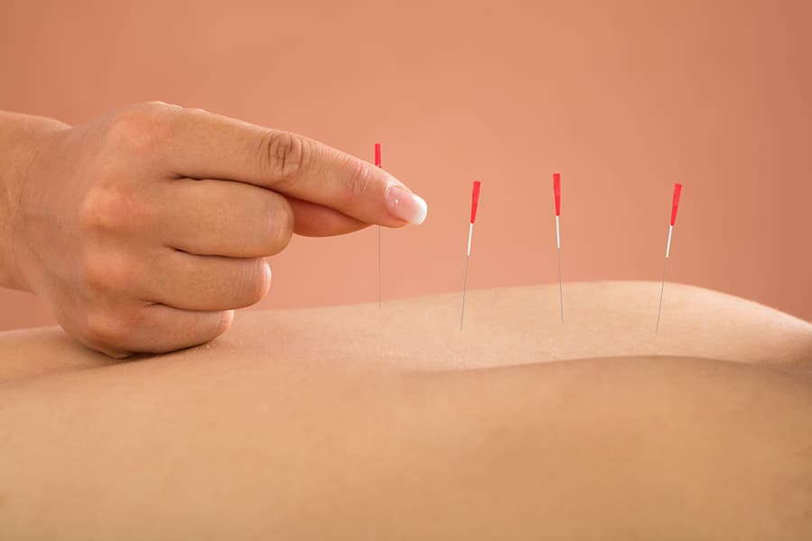 Acupuncture