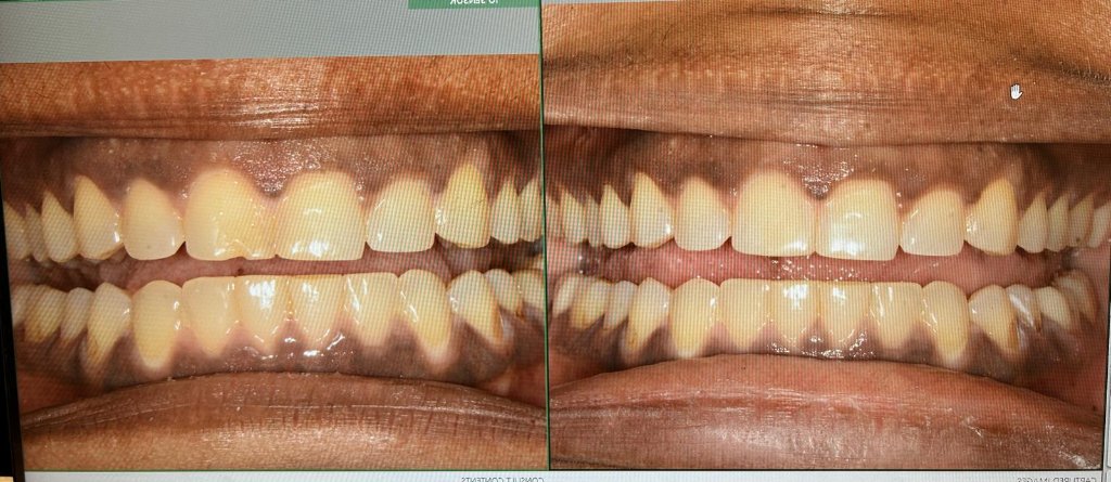 Smile Restoration — before and after dental transformation