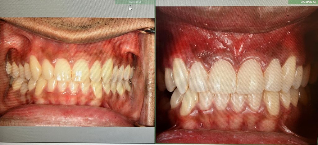 Functional Restoration — before and after dental transformation