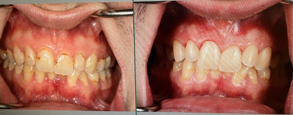 Brightening & Cleaning — before and after dental transformation