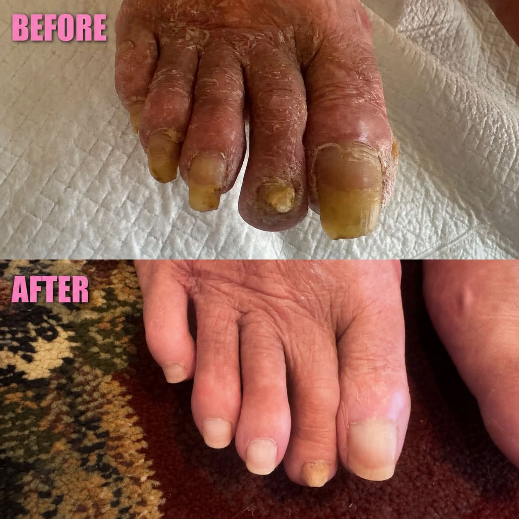 Before and after a professional medical pedicure