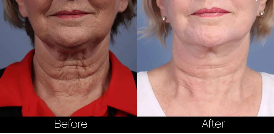 Non-Surgical Facelift & Necklift before and after
