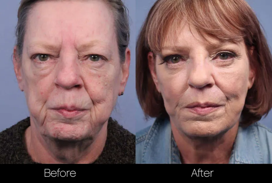 Non-Surgical Facelift & Necklift before and after