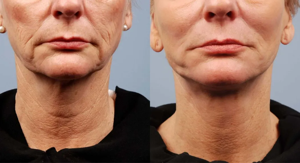 Non-Surgical Facelift & Necklift before and after