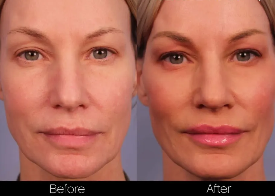 Non-Surgical Facelift & Necklift before and after