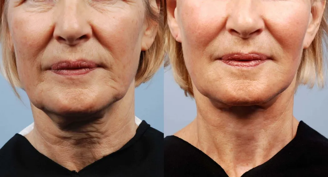 Non-Surgical Facelift & Necklift before and after