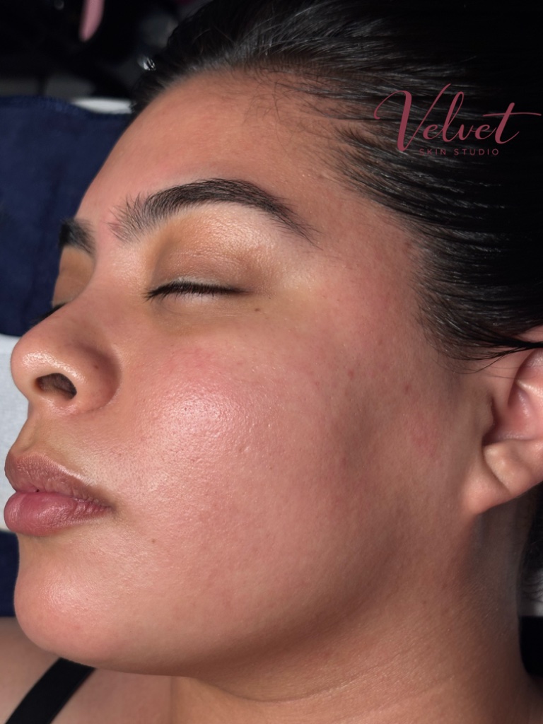 Velvet Dermaplaning Facial
