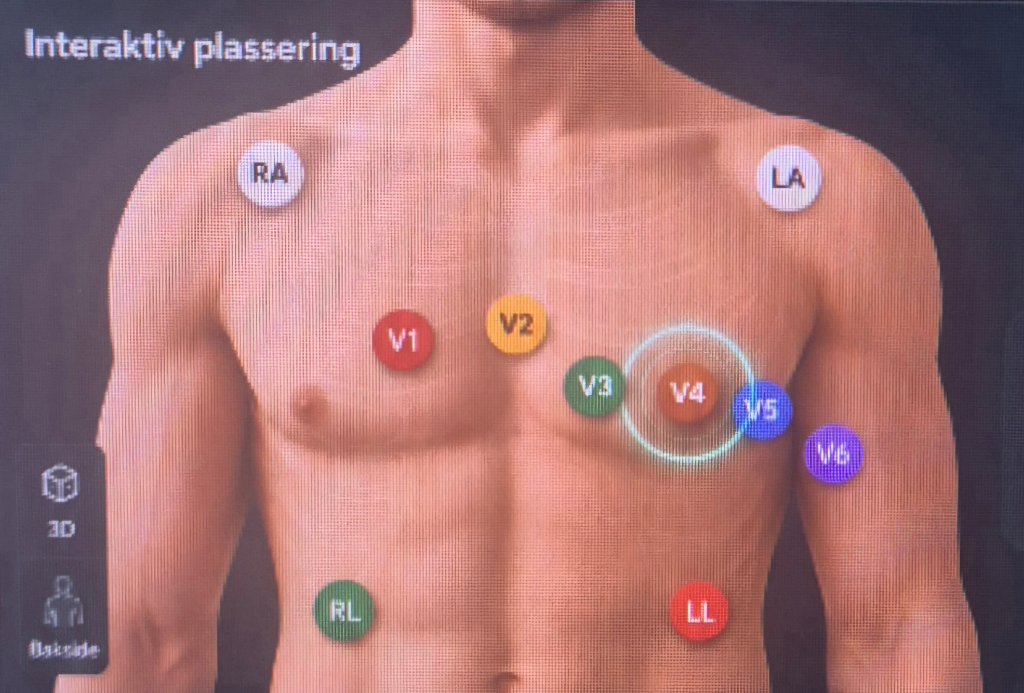 EKG-elektrodeplassering på torso