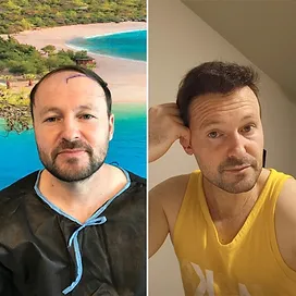 Crown Density Restoration — treatment-provider before and after example