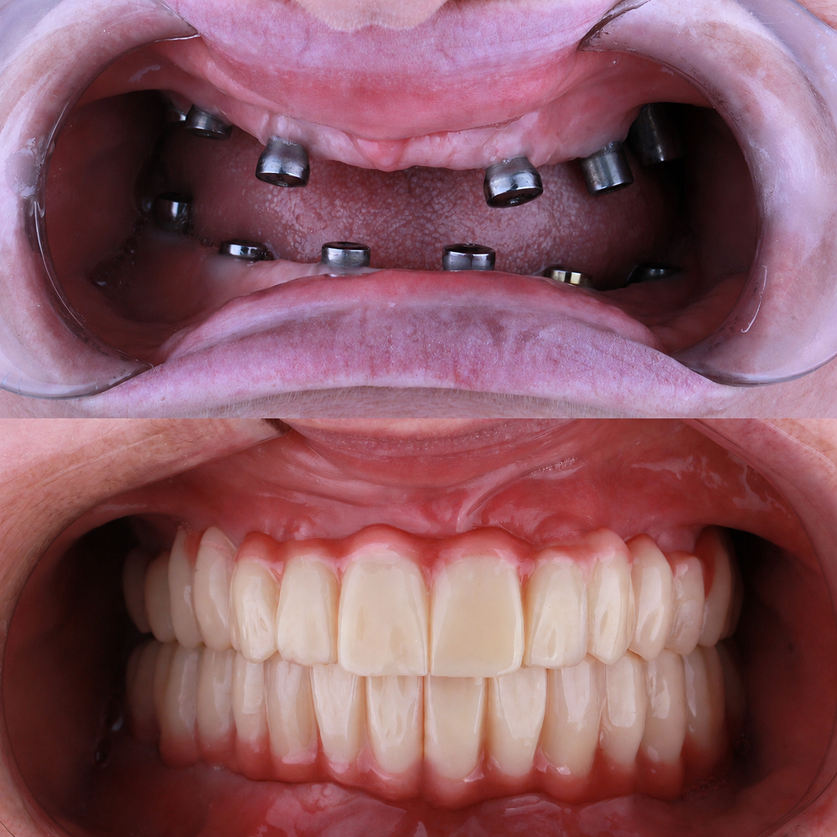 Dental before and after — Implant restoration case