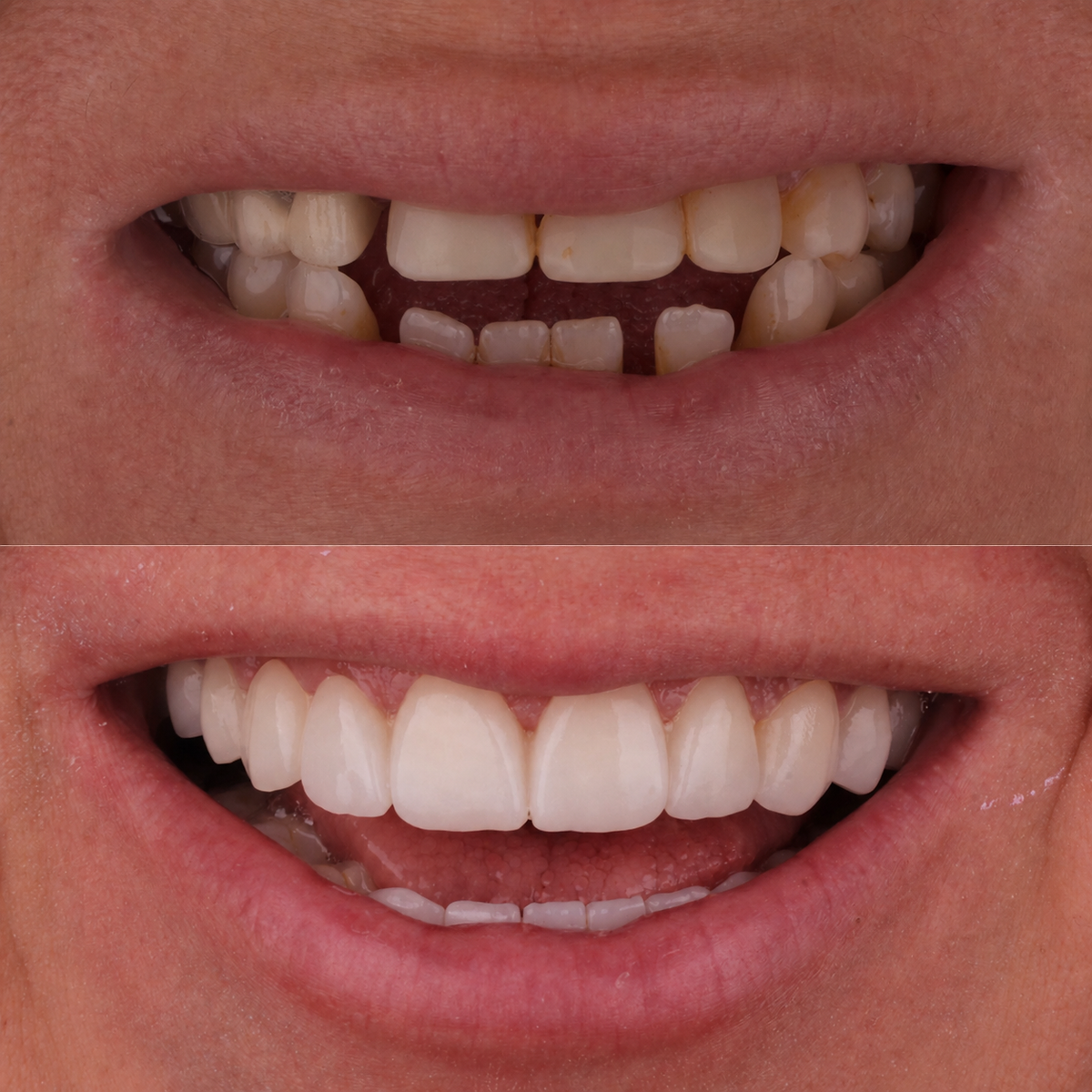 Dental before and after — Full arch restoration case