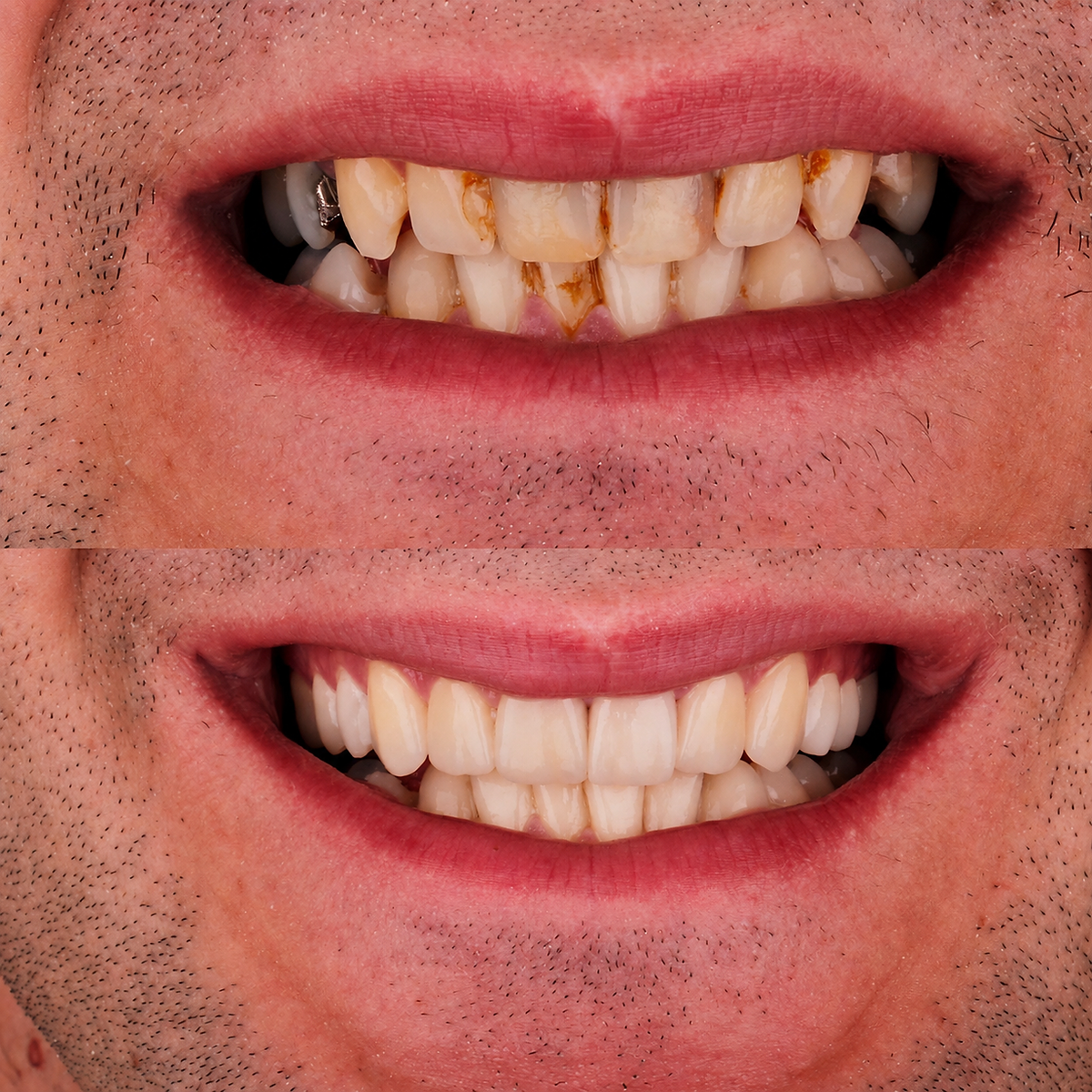 Dental before and after — Restoration case