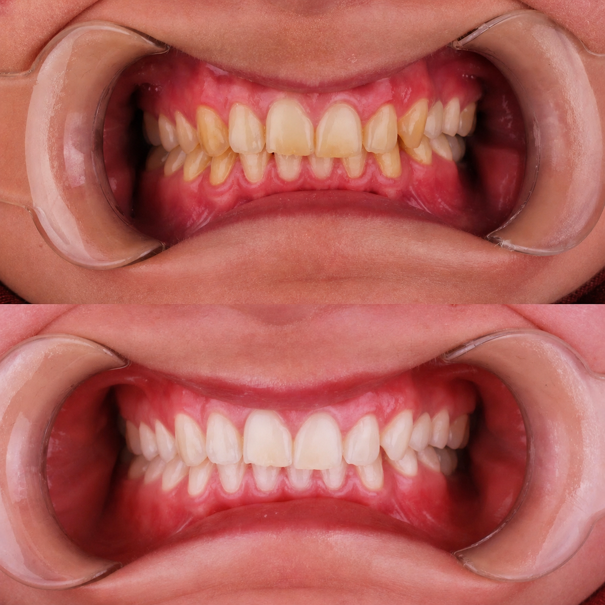 Dental before and after — Alignment case