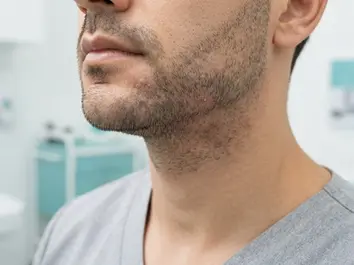 Beard bumps and ingrown hair treatment at ProLaserSpa Paphos