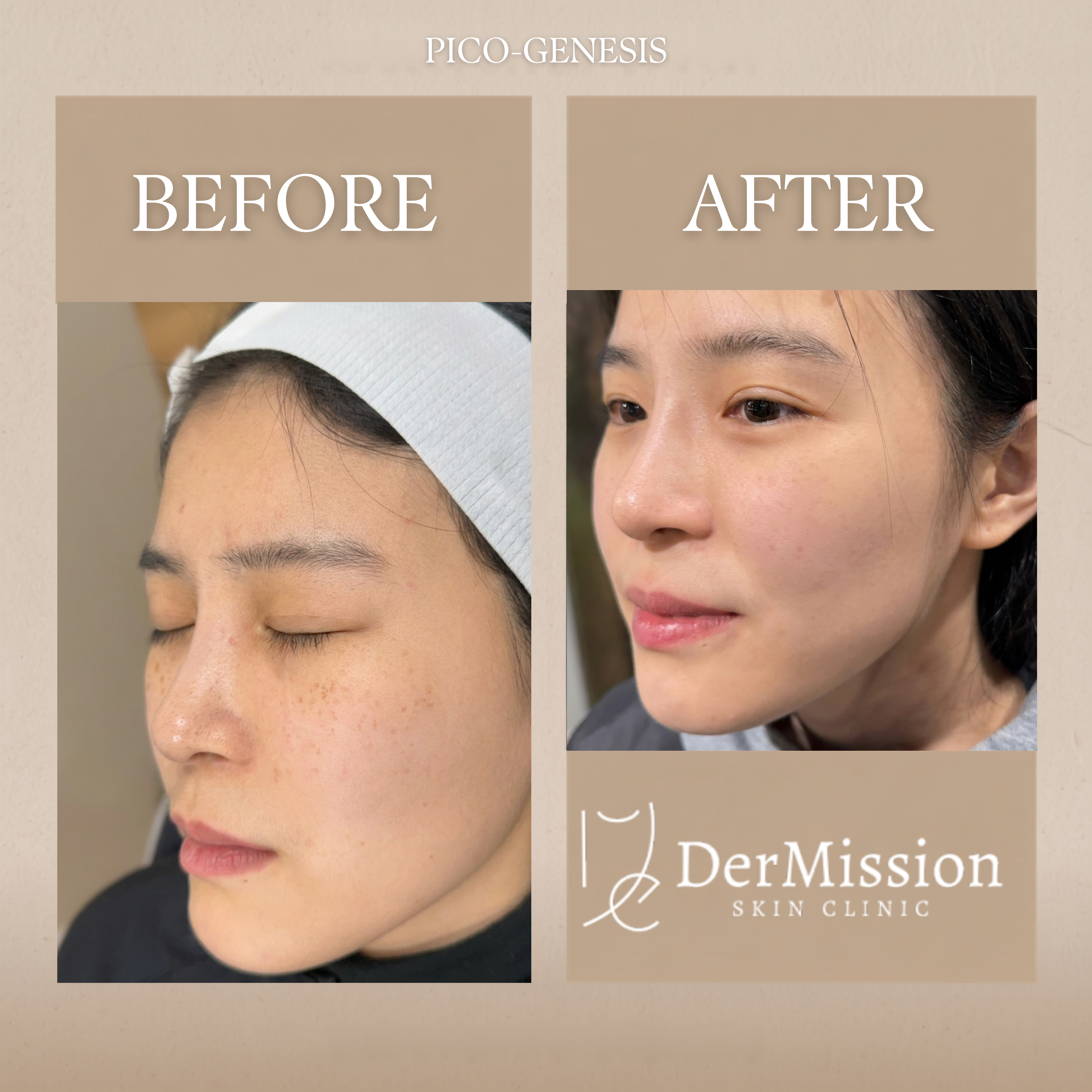 PicoGenesis before and after results card 2