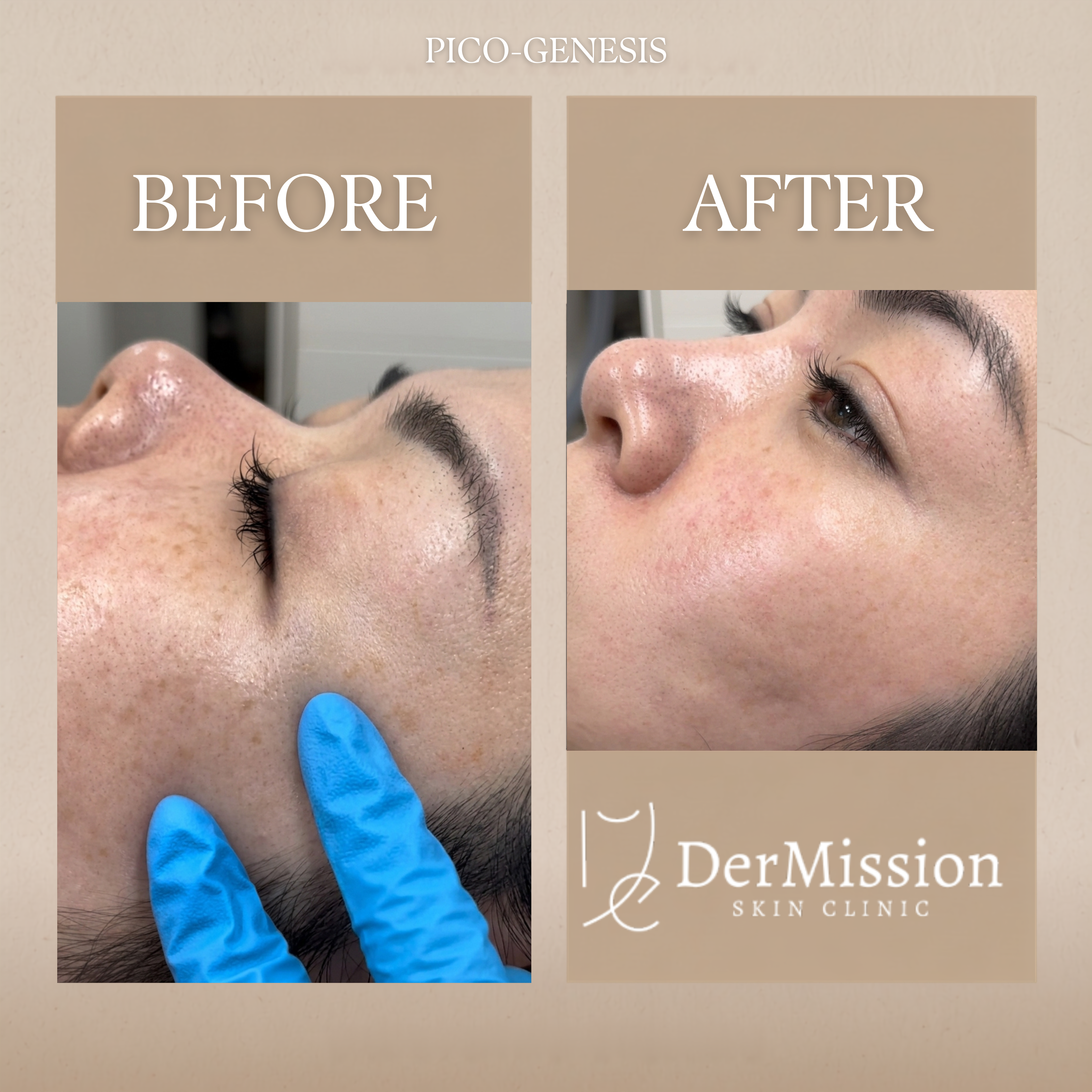 PicoGenesis before and after results card 3
