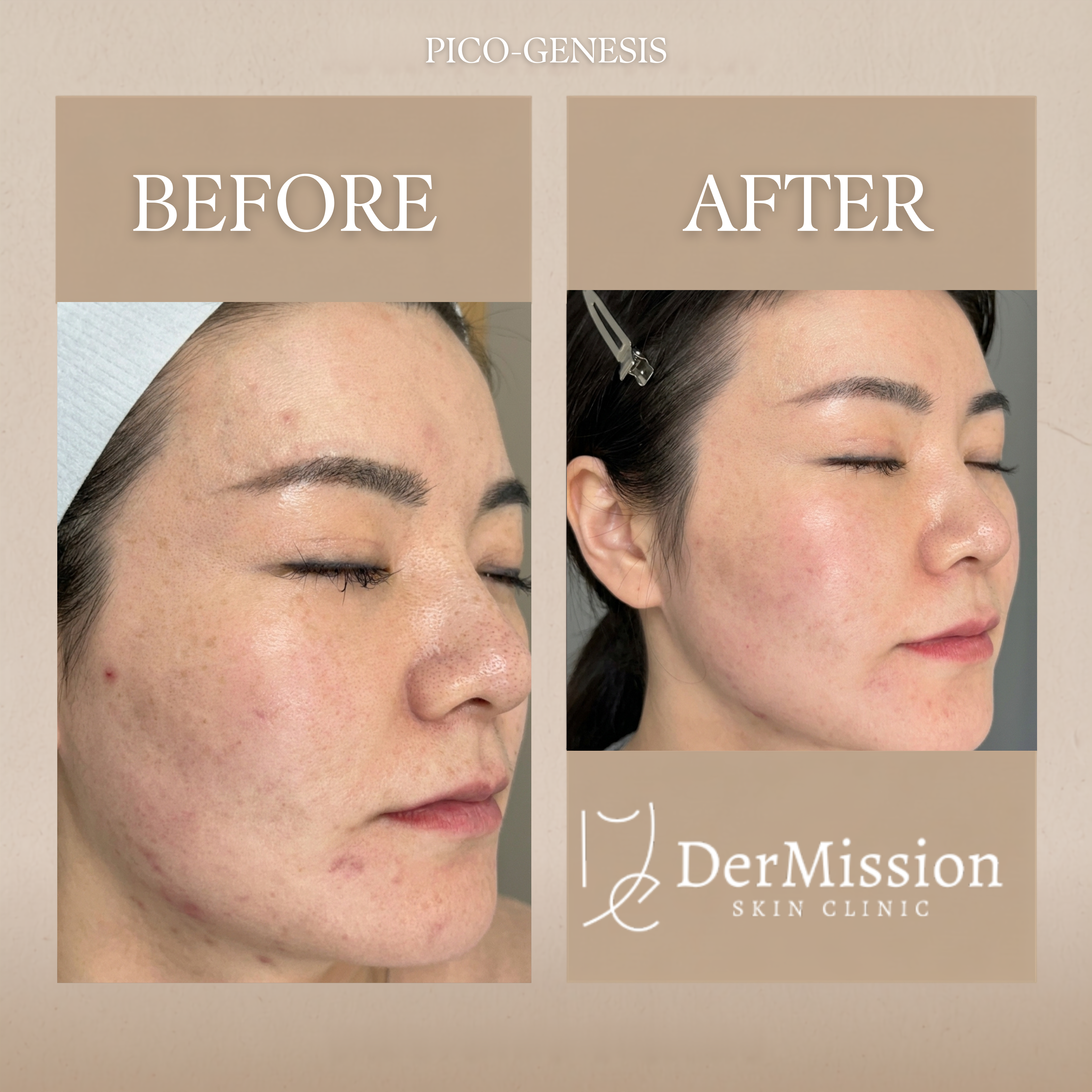 PicoGenesis before and after results card 1