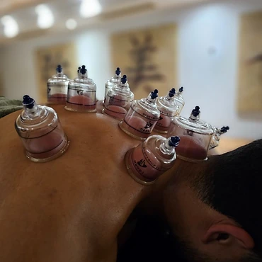 Cupping therapy treatment at Fadeaway Sports Massage and Therapy