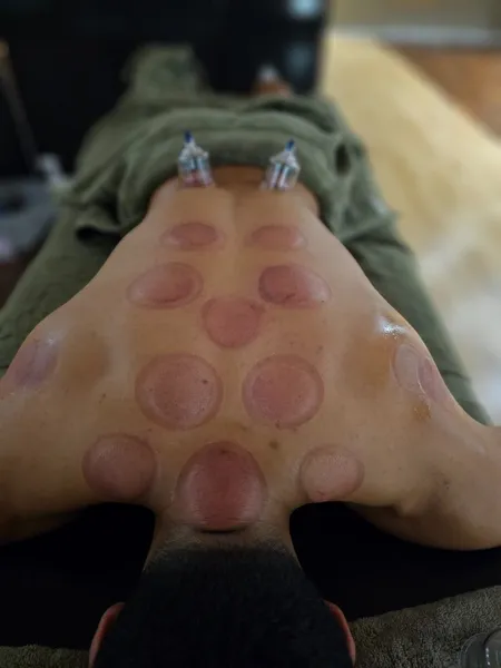 Fresh cupping marks across the upper back and shoulders