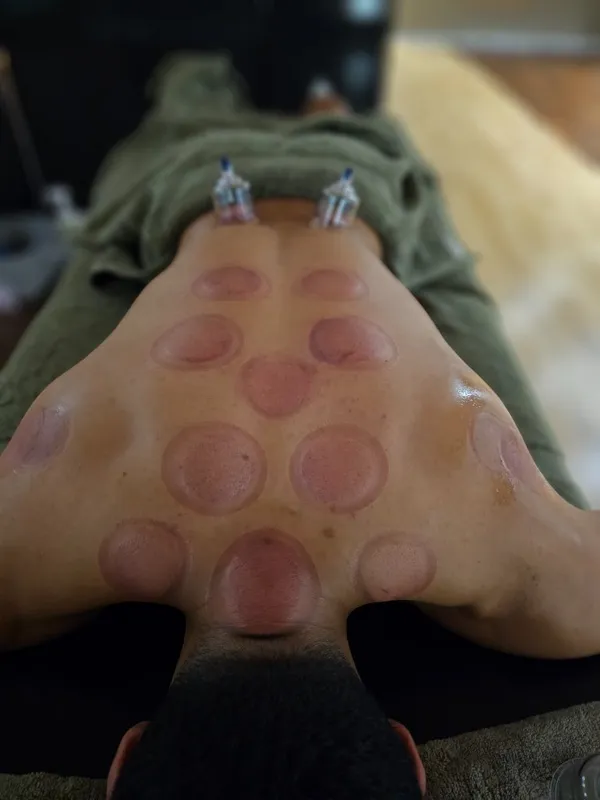 Fresh cupping marks across the upper back and shoulders