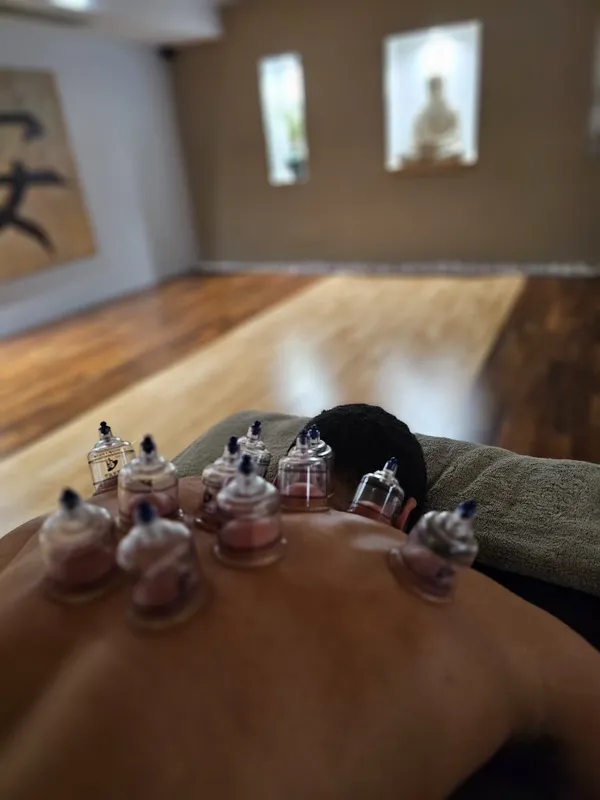 Symmetrical cupping placement either side of the spine