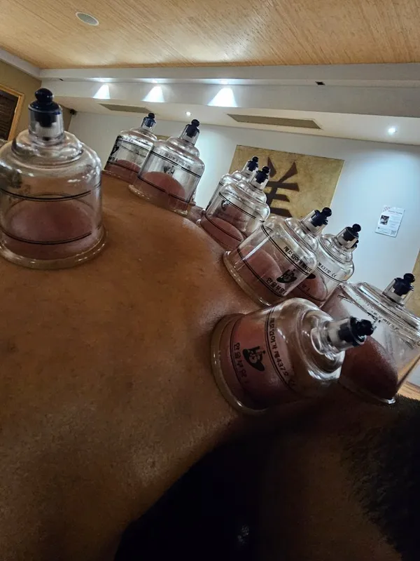 Close up of cupping therapy showing the suction effect across the upper back
