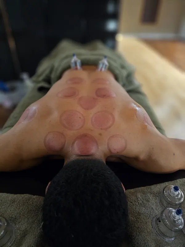 Cupping therapy in a calm professional clinic setting