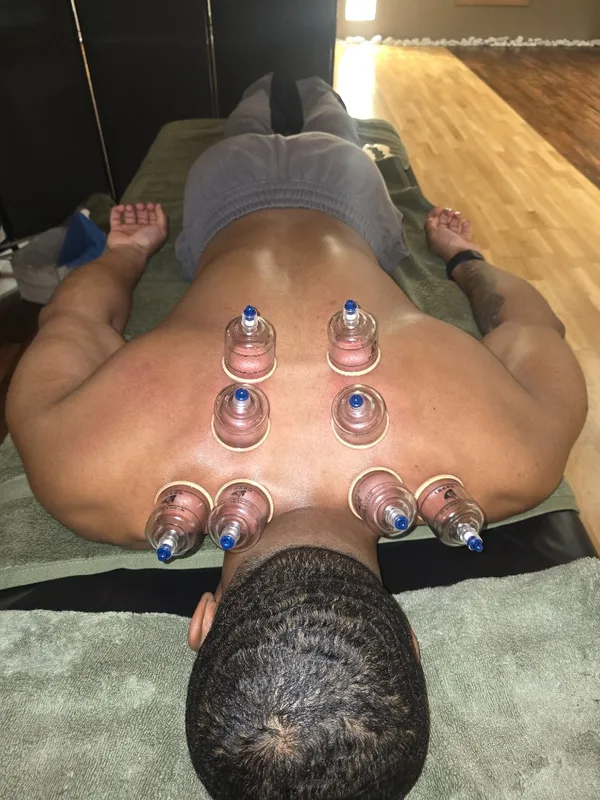 Six vacuum cups applied across the upper back