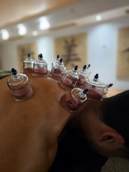 Cupping cups placed across the shoulders and upper back