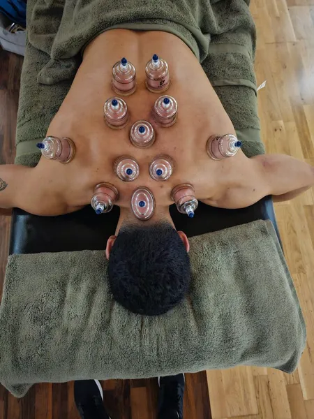 Cupping therapy session in progress at our Gloucester clinic