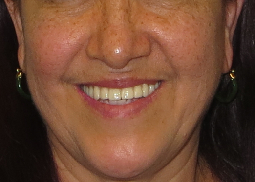 Restauración de arcada completa con implantes — after