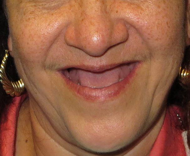 Restauración de arcada completa con implantes — before