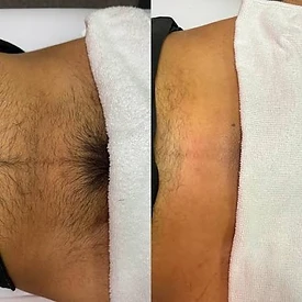 Manzilian laser hair removal before and after