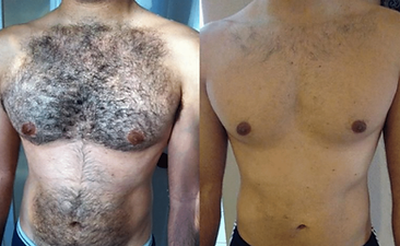Chest and abdomen laser hair removal before and after