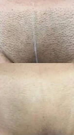 Brazilian laser hair removal before and after
