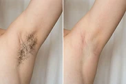 Underarm laser hair removal before and after on light skin