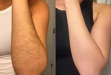 Full arm laser hair removal before and after
