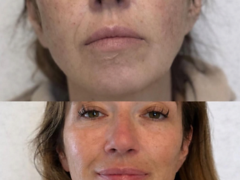 Skin Renewal