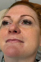 Lip Filler before