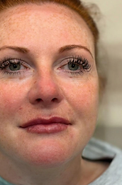 Lip Filler after