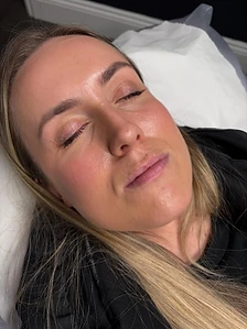 Lip fillers — before