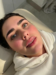Lip fillers — after