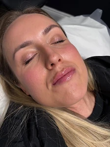 Lip fillers — after