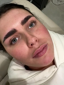 Lip fillers — before