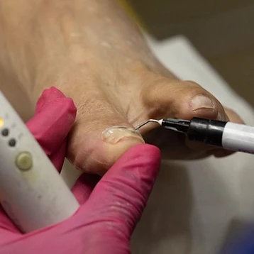 Órteses de Silicone