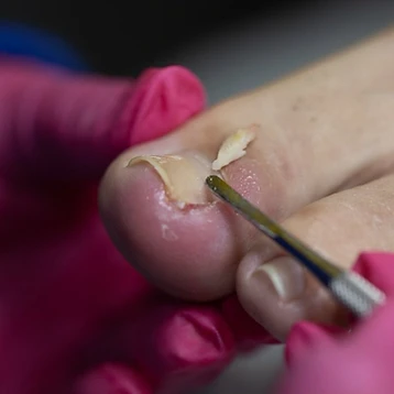 Tratamento de Unhas Encravadas